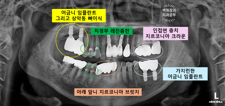 치주염으로 흔들리는 앞니부터 어금니 뼈이식 임플란트까지 - 5개월간 정성스러운 치료 과정. 관련 이미지 21