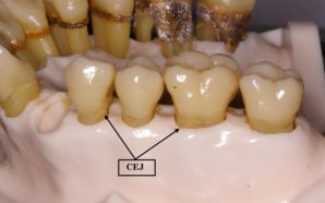 잇몸치료에 대한 모든 것. 치주과 전문의가 설명하는 치주염 치료 비용,과정, 통증, 방법 그리고 치과 실비보험. 관련 이미지 6