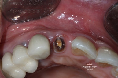 외과적 정출술 (surgical extrusion) - 치아를 살리는 마지막 방법. 치료과정/치료기간/비용/사진. 관련 이미지 3