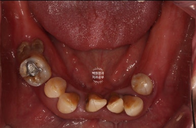 임플란트장인의 마음으로 8개월간 전체임플란트 완성. 치주과 전문의. 관련 이미지 7