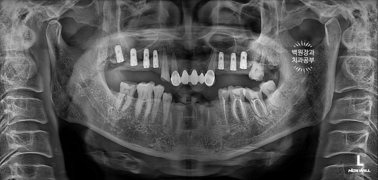 뿌리만 남은 앞니, 어금니가 없어 교합이 무너진 증례. 흡연자의 전체 오스템BA임플란트 재건증례. 치료과정/치료기간/비용/후기. 관련 이미지 8