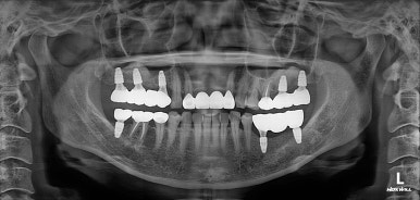 전세계 1위 스트라우만 임플란트를 사용한 어금니 기능회복과 앞니 지르코니아 크라운 증례. 관련 이미지 31