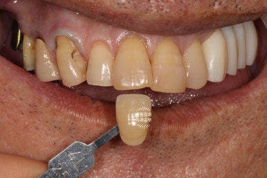 아래 어금니 임플란트 6개면 틀니를 안써도 됩니다.  치주염 전문 착한치과. 치료기간/임시치아과정/후기/비용. 관련 이미지 23