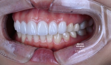 신사역 퍼스널컬러 맞춤 치과. 전담 세라미스트가 앞니 크라운과 라미네이트를 만들어 드립니다. 관련 이미지 12