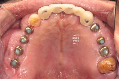 뿌리만 남은 앞니, 어금니가 없어 교합이 무너진 증례. 흡연자의 전체 오스템BA임플란트 재건증례. 치료과정/치료기간/비용/후기. 관련 이미지 18