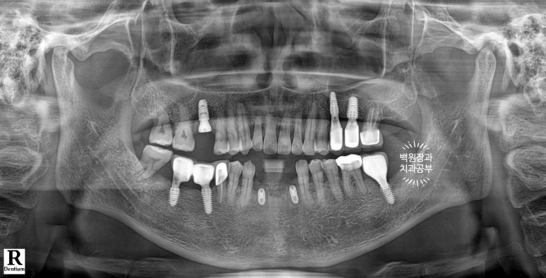 Seoul Sinsa Station [Lev Dental Clinic] For chronic periodontitis, extract the lower front teeth and make the crown look even more real than the real thing with an implant. image 6