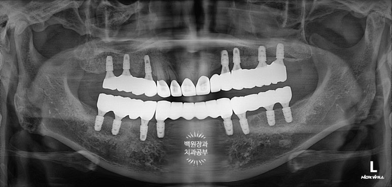 임플란트장인의 마음으로 8개월간 전체임플란트 완성. 치주과 전문의. 관련 이미지 33