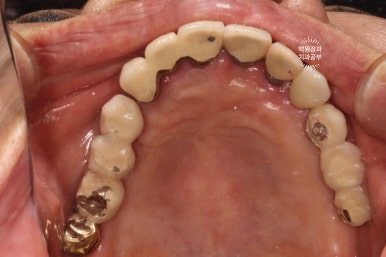스트라우만 임플란트로 이뽑고 바로심는치과 - 믿고 사용하는 세계 1위 스위스 임플란트 회사. 관련 이미지 34