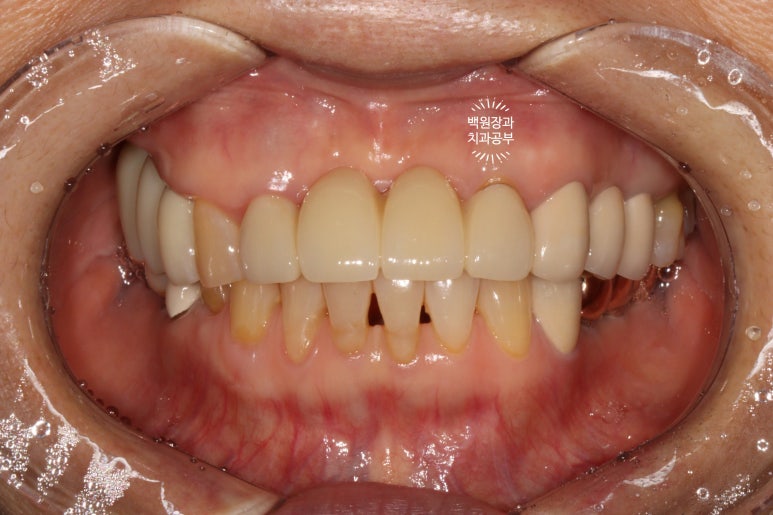 60대 임플란트 주변에서 고름이 나와요. 실패한 임플란트 제거 후 재수술. 덴티움 뼈이식재를 사용한 치조골 이식술. 관련 이미지 18