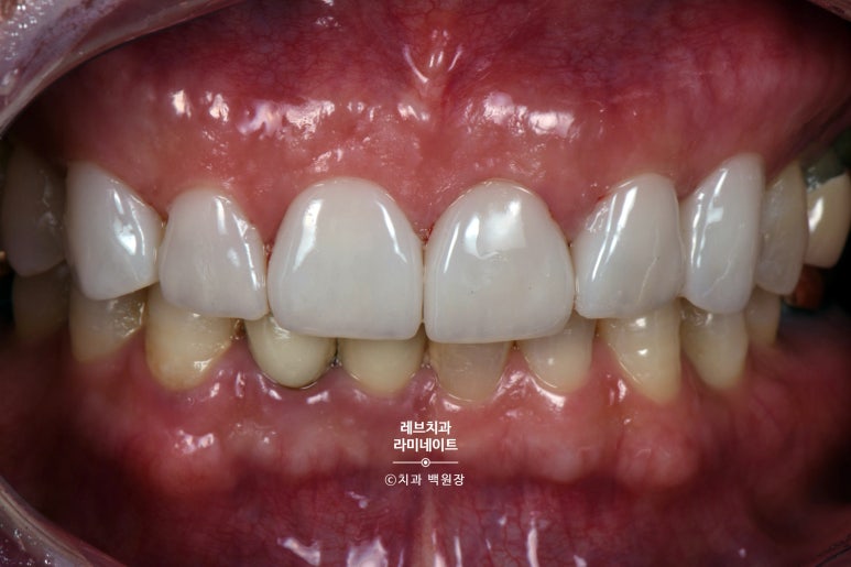 신사역 무삭제 라미네이트 : 레브네이트 내츄럴 최소삭제 비니어. 50대 앞니 벌어짐 비용/후기/얼굴사진. 관련 이미지 11