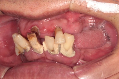 만성치주염으로 인해 아주 좁아진 잇몸뼈에 광범위한 뼈이식 + 전체임플란트. 신사 레브치과. 관련 이미지 6