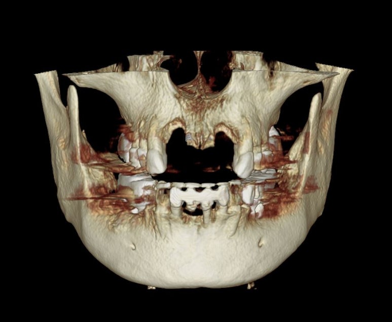 앞니가 풍치로 흔들거려요. 심한 치주염인데 임플란트 가능할까요? 치료과정/치료기간/비용/성공후기. 신금호역 치과 추천. 관련 이미지 10