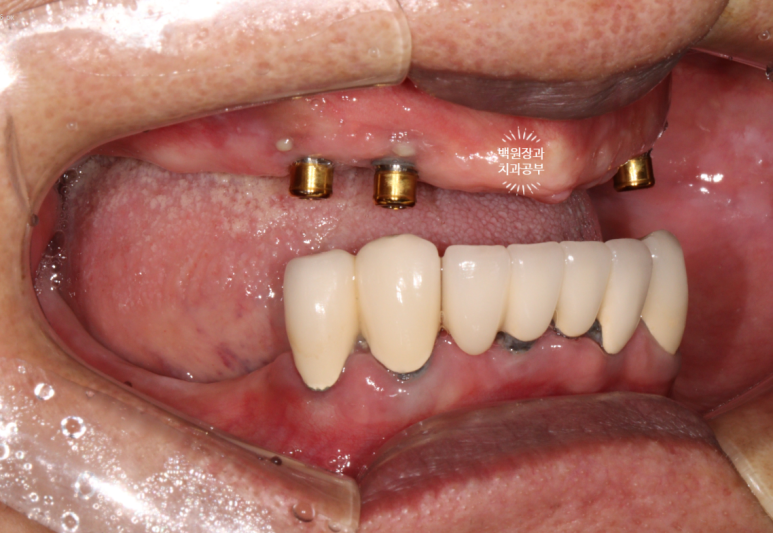 임플란트에서 고름이 나와요. 임플란트 주위염 그리고 재수술을 위한 준비. 치료과정/치료기간/비용/후기. 관련 이미지 5