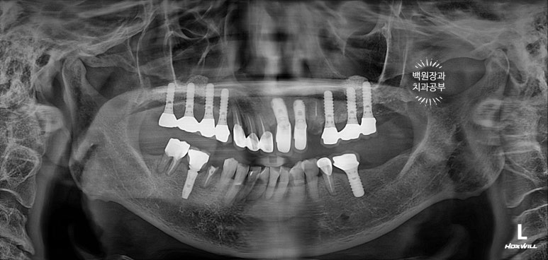 스트라우만 임플란트로 이뽑고 바로심는치과 - 믿고 사용하는 세계 1위 스위스 임플란트 회사. 관련 이미지 2
