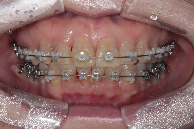 삐뚤어진 앞니를 8개월만에 가지런하게 만드는 50대 성인부분교정. 신사역 교정치과. 치료과정/기간/비용. 관련 이미지 10