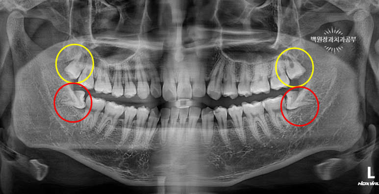매복 사랑니 10분만에 뽑기! 치료과정/치료기간/비용/후기. 관련 이미지 3