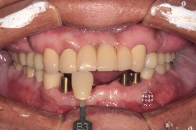 뿌리만 남은 앞니, 어금니가 없어 교합이 무너진 증례. 흡연자의 전체 오스템BA임플란트 재건증례. 치료과정/치료기간/비용/후기. 관련 이미지 24