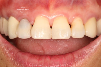 외과적 정출술 (surgical extrusion) - 치아를 살리는 마지막 방법. 치료과정/치료기간/비용/사진. 관련 이미지 10