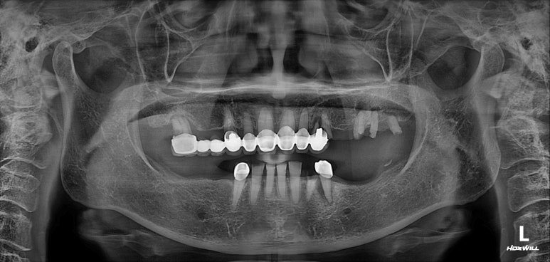 어금니 여러개가 없어요. 전체 임플란트와 앞니 크라운을 통한 완벽한 재건!! 치료과정/치료기간/비용/후기. 관련 이미지 7
