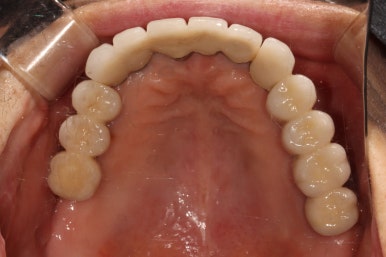 부분틀니를 오래써서 어금니가 아플 때, 아래턱 양쪽 어금니 임플란트 잘하는 강남임플란트치과 관련 이미지 25
