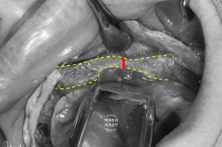 만성치주염으로 인해 아주 좁아진 잇몸뼈에 광범위한 뼈이식 + 전체임플란트. 신사 레브치과. 관련 이미지 22