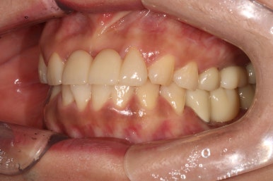 전세계 1위 스트라우만 임플란트를 사용한 어금니 기능회복과 앞니 지르코니아 크라운 증례. 관련 이미지 23