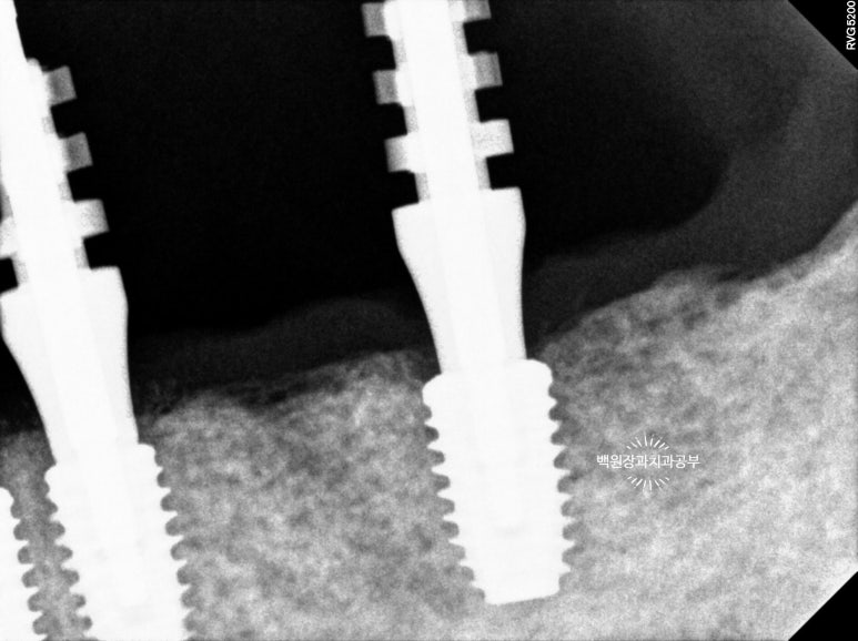 오스템임플란트 네비게이션 전체 임플란트 치료일기. 치료과정/치료기간/비용/솔직후기. 관련 이미지 17