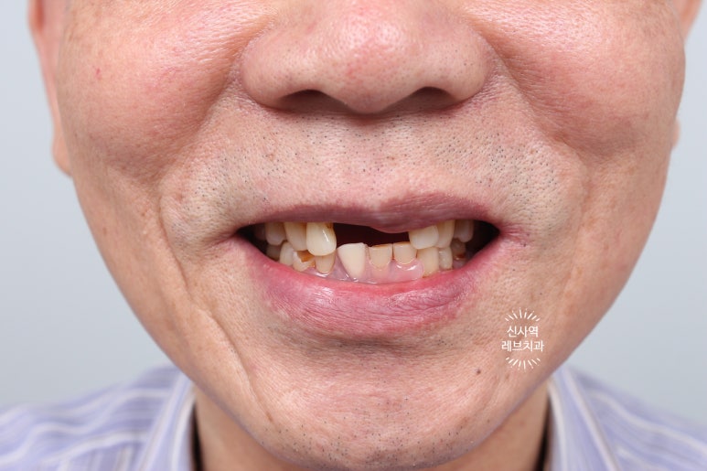 신사역 앞니 임플란트 잘하는 레브치과. 가격/비용/사진/후기. (프로포폴 수면가능) 관련 이미지 14