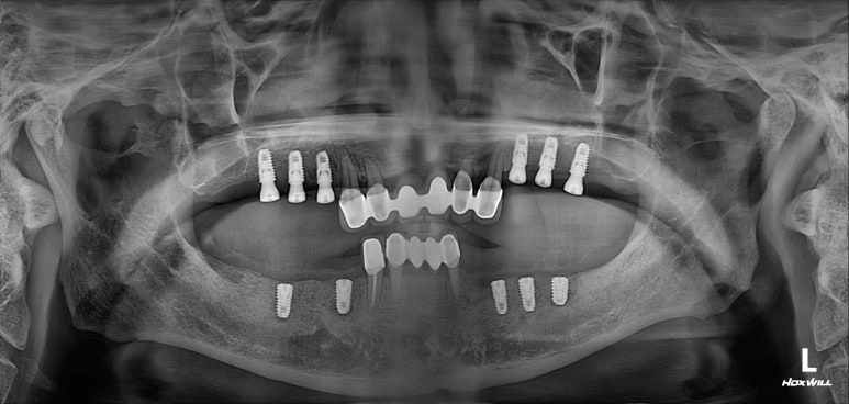 잇몸 염증 고름이 심했던 부위 - 만성치주염 진단하고 임플란트로 깔끔하게 치료! 신사역 치과 관련 이미지 21