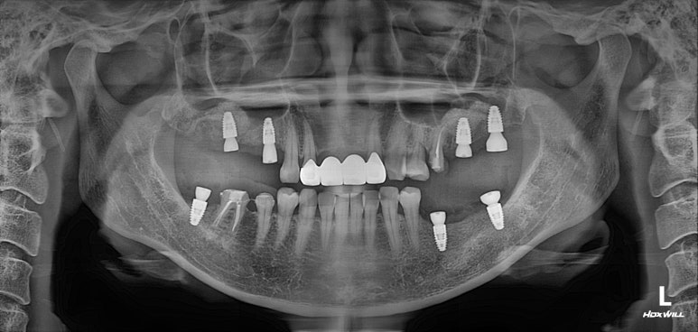 전세계 1위 스트라우만 임플란트를 사용한 어금니 기능회복과 앞니 지르코니아 크라운 증례. 관련 이미지 16