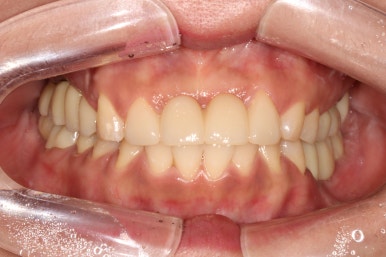 전세계 1위 스트라우만 임플란트를 사용한 어금니 기능회복과 앞니 지르코니아 크라운 증례. 관련 이미지 21