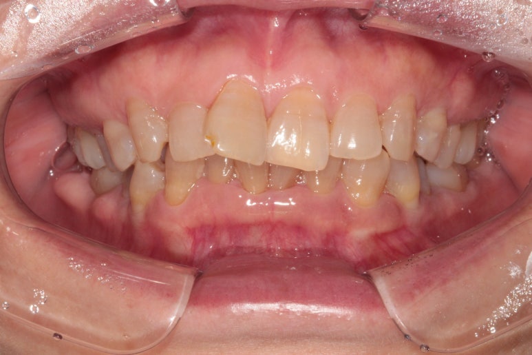 삐뚤어진 앞니를 8개월만에 가지런하게 만드는 50대 성인부분교정. 신사역 교정치과. 치료과정/기간/비용. 관련 이미지 2