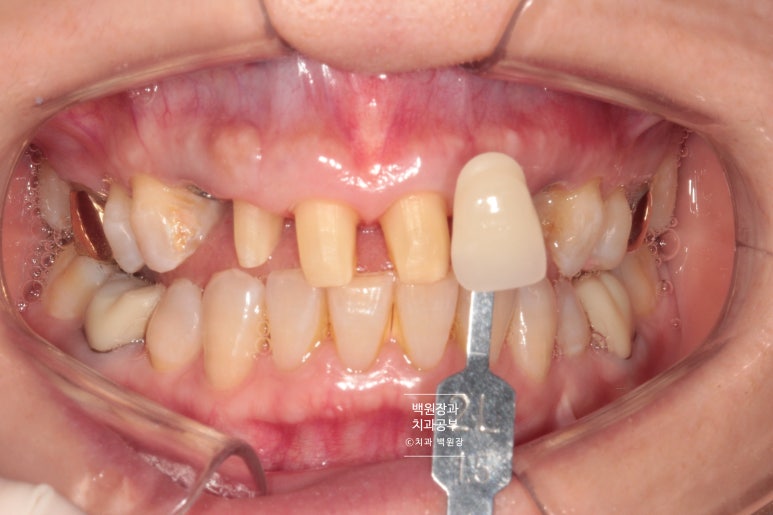 크라운 앞니 충치로 냄새가 나요 - 최소한의 임플란트와 씌우는 치료. 치료과정/기간/비용. 관련 이미지 12