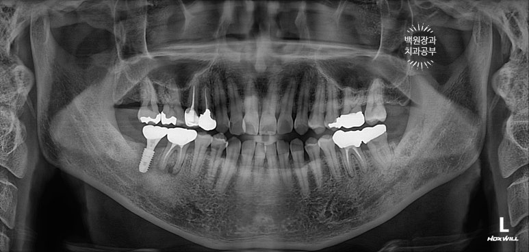 신경치료한 치아 부러짐! 뼈이식 하면서 임플란트 수술하는 과정/기간/비용. 관련 이미지 17