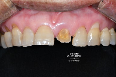 강남논현동치과 60대 치아부러짐 - 신경치료하고 기둥심고 앞니 크라운 잘하는곳! 가격/과정/후기/부작용. 관련 이미지 15