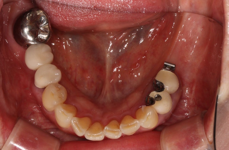 어금니 임플란트 주변 잇몸이식수술 - 저는 해야한다고 생각합니다. (feat. 대한치과의사협회 논문 + 치주과전문) 관련 이미지 27