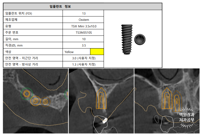 만성치주염으로 인해 아주 좁아진 잇몸뼈에 광범위한 뼈이식 + 전체임플란트. 신사 레브치과. 관련 이미지 14