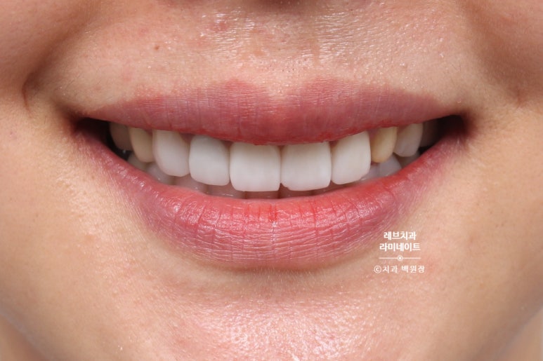 신사역 퍼스널컬러 맞춤 치과. 전담 세라미스트가 앞니 크라운과 라미네이트를 만들어 드립니다. 관련 이미지 7
