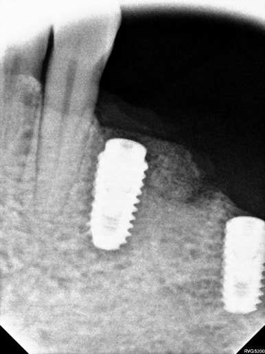 어금니 임플란트 주변 잇몸이식수술 - 저는 해야한다고 생각합니다. (feat. 대한치과의사협회 논문 + 치주과전문) 관련 이미지 16