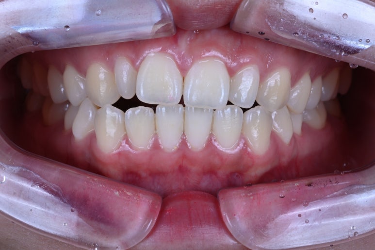 왜소치 라미네이트. 열심히 교정치료 받은 나를 위한 선물. 비용/과정/후기. 관련 이미지 2