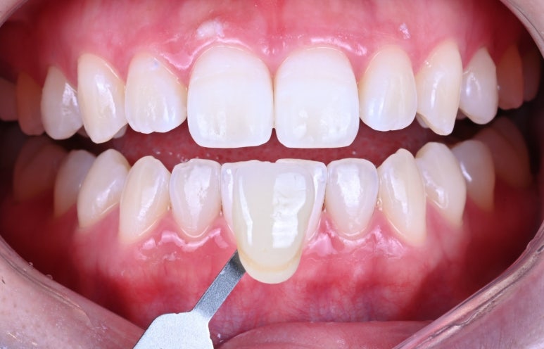 강남 치아미백 성지 레브치과. 가격/비용/부작용/전후사진. 관련 이미지 12