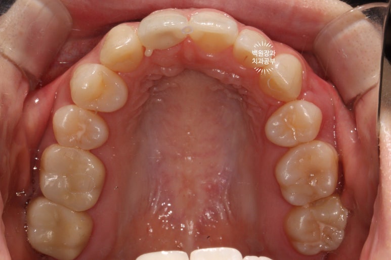 잇몸 성형과 치아미백 그리고 지르코니아 20대 앞니 크라운 치료. 치료과정/기간/비용. 관련 이미지 15