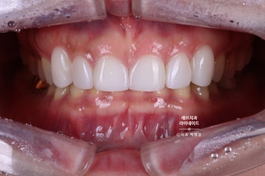 아래앞니 라미네이트도 무삭제로 가능한가요? 레브네이트 베이직 가격/비용/후기/추천. 관련 이미지 12