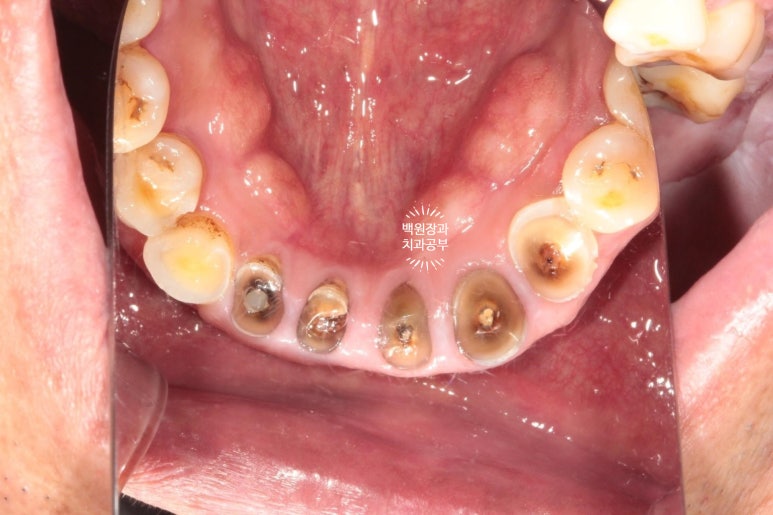 뿌리만 남은 앞니, 어금니가 없어 교합이 무너진 증례. 흡연자의 전체 오스템BA임플란트 재건증례. 치료과정/치료기간/비용/후기. 관련 이미지 6