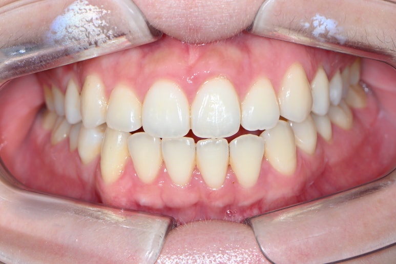 옆면 어금니 충치 하루만에 가능한 논현동 치과. 치아미백 가격 후기. 관련 이미지 2