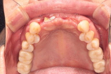 앞니가 풍치로 흔들거려요. 심한 치주염인데 임플란트 가능할까요? 치료과정/치료기간/비용/성공후기. 신금호역 치과 추천. 관련 이미지 23
