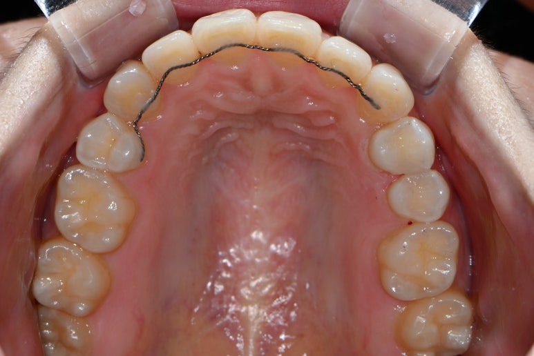 옆면 어금니 충치 하루만에 가능한 논현동 치과. 치아미백 가격 후기. 관련 이미지 8