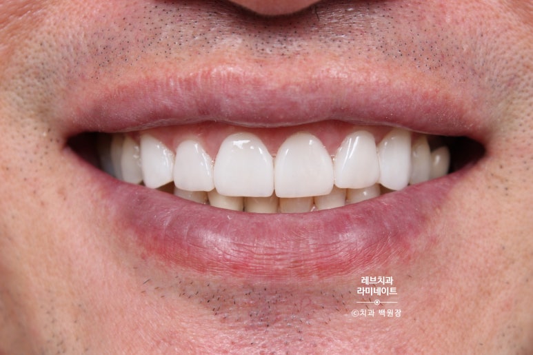 신사역 무삭제 라미네이트 : 레브네이트 내츄럴 최소삭제 비니어. 50대 앞니 벌어짐 비용/후기/얼굴사진. 관련 이미지 14