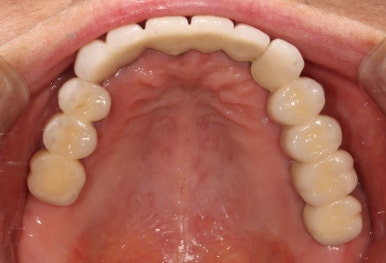 부분틀니를 오래써서 어금니가 아플 때, 아래턱 양쪽 어금니 임플란트 잘하는 강남임플란트치과 관련 이미지 7