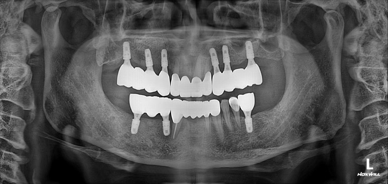 큰 어금니를 잃을 정도의 풍치를 앓으셨다면, 조속한 어금니 임플란트는 필수입니다. 관련 이미지 13